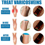 Varicose Veins Treatment Spray - Veins Relief Oil